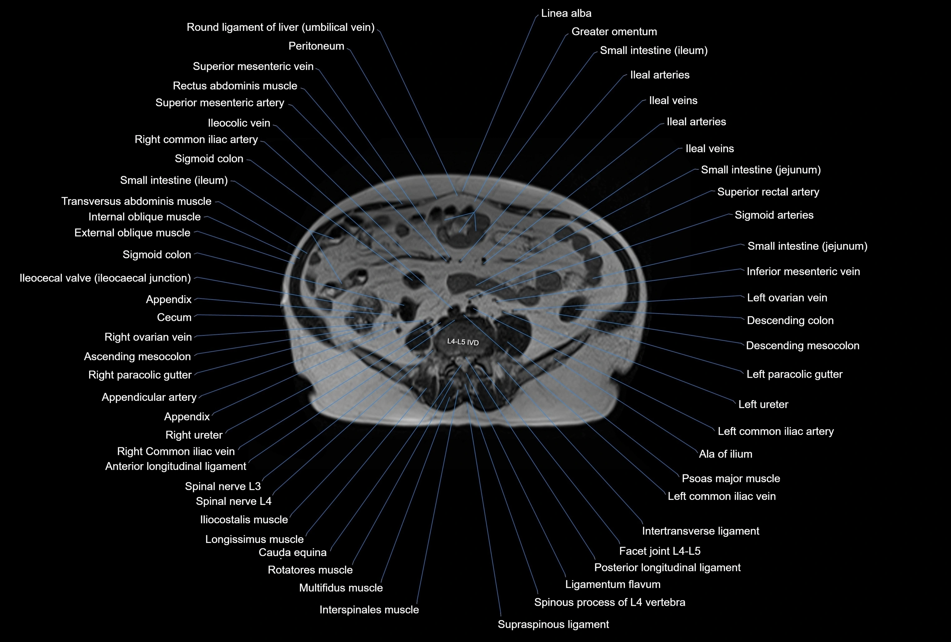 MRI Abdomen axial cross sectional anatomy radiology  image-img-00001-00034.webp